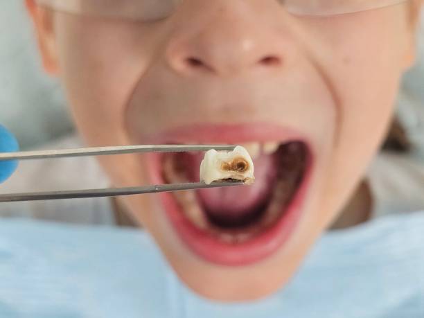 Best Emergency Tooth Extraction in Berkley, MI